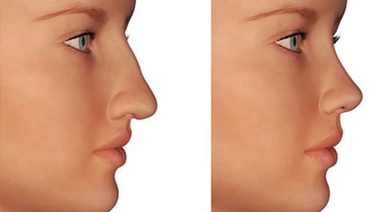 How Much The Price Of Rhinoplasty In Turkey Sonhaberler