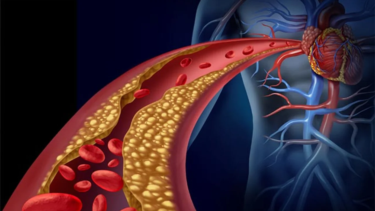 Kolesterol nedir, kolestrol tedavisi nasıl olur? - SonHaberler