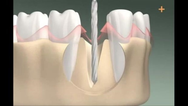 Diş implantı böyle yapılıyor - Sayfa 2