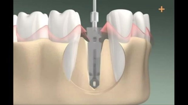 Diş implantı böyle yapılıyor - Sayfa 3