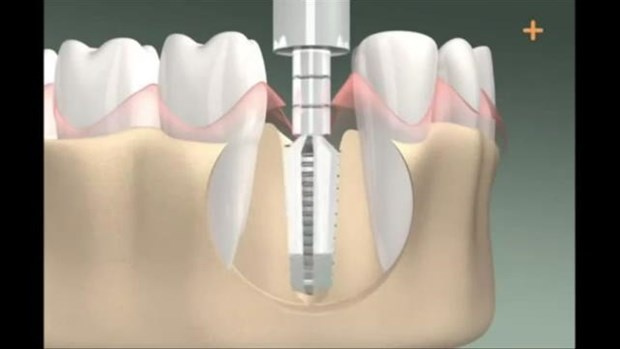 Diş implantı böyle yapılıyor - Sayfa 4